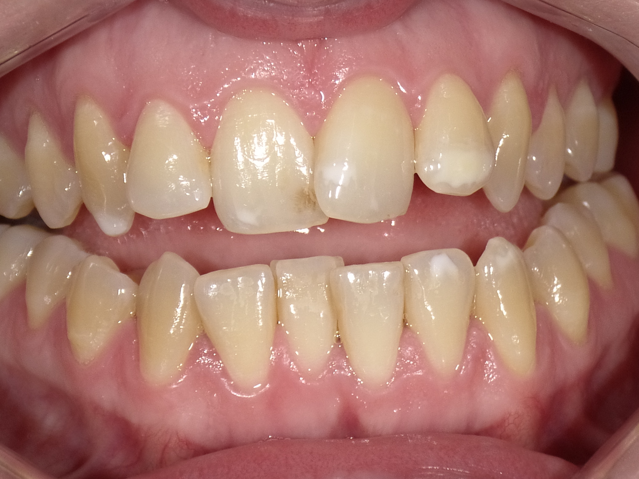 Oberkiefer Frontzähne mit Schmelzflecken